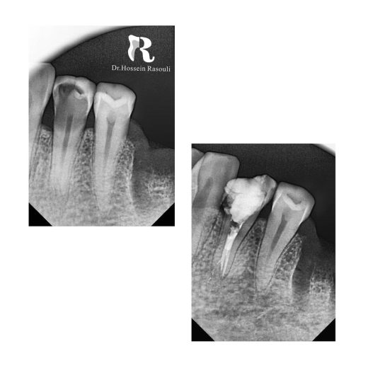 پرمولر سه کانال پایین